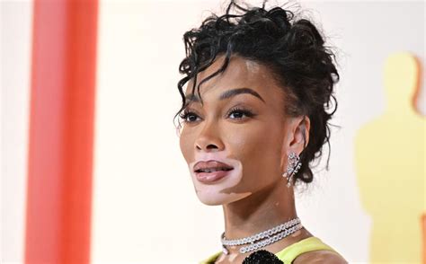 vitiligo nude|Winnie Harlow Proudly Shows Off Her Vitiligo In Stunning Body